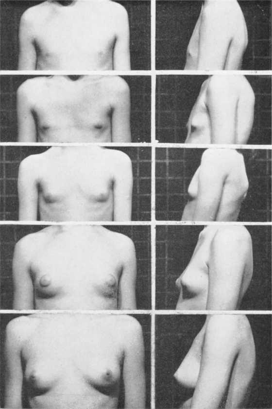 图5,乳房发育的五个阶段,如上文描述。
