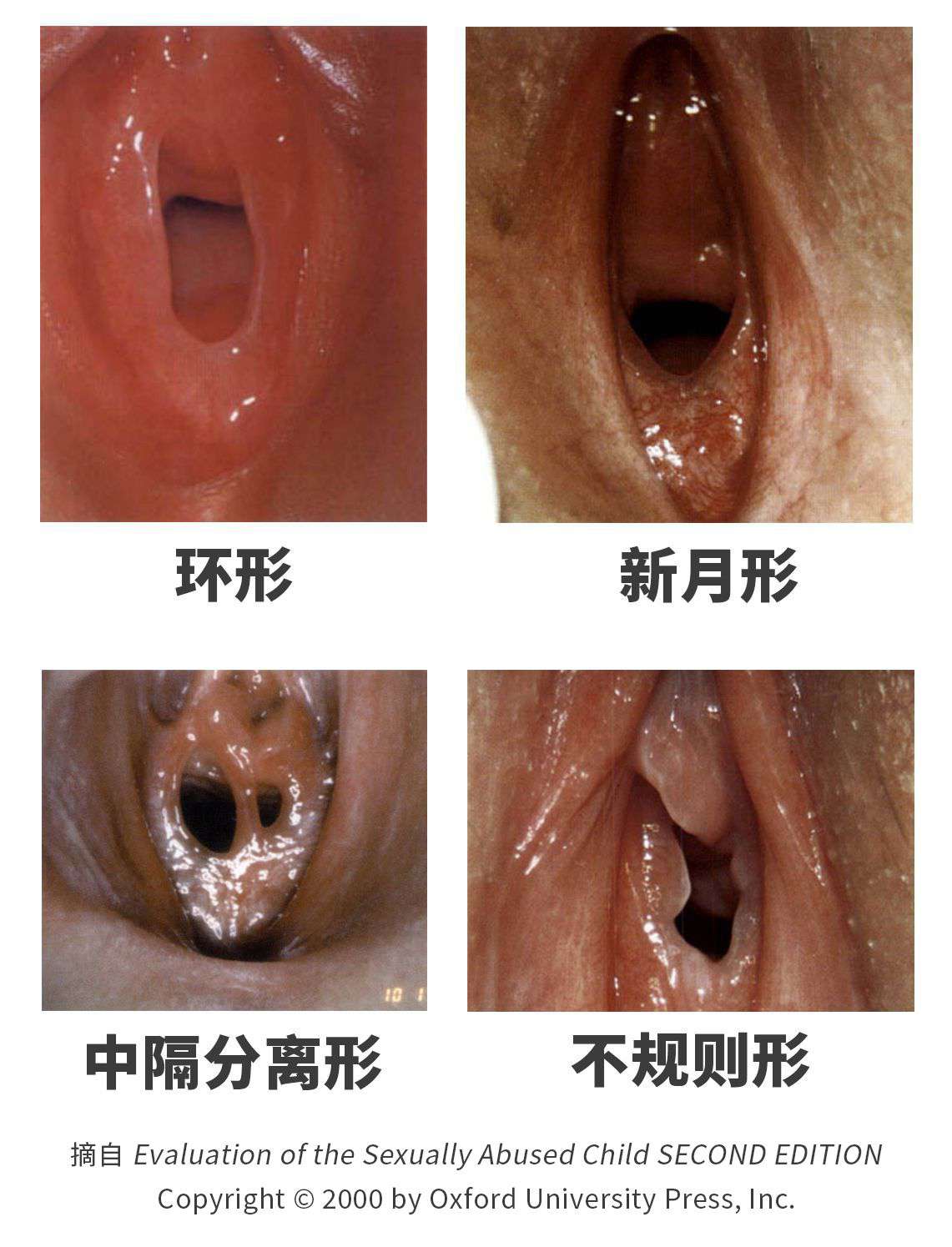 图 6,处女膜的其中四种形态